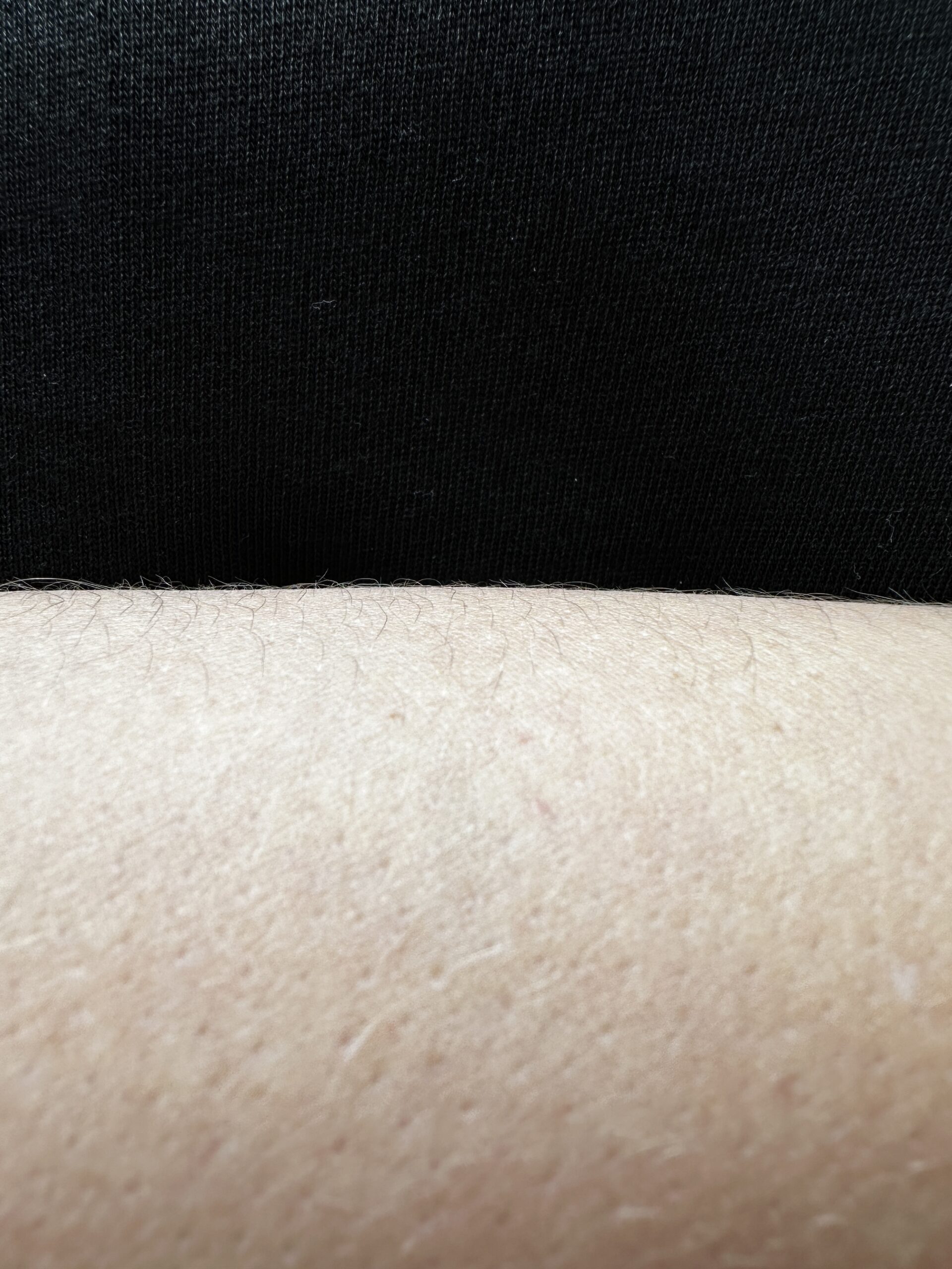 úbytek chloupků IPL před a po úbytek chloupků IPL před a po