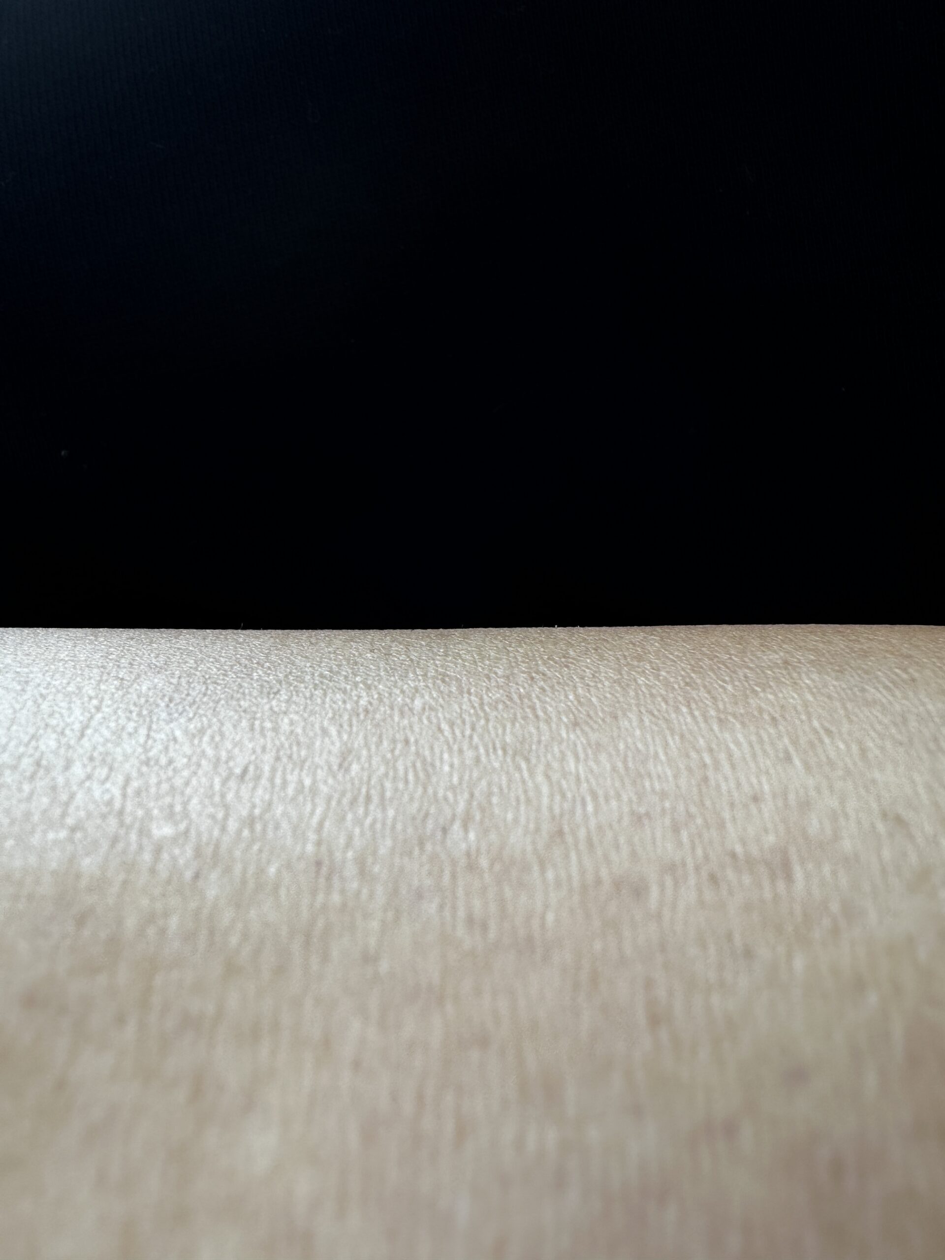 úbytek chloupků IPL před a po úbytek chloupků IPL před a po